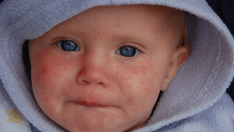 Measles baby
