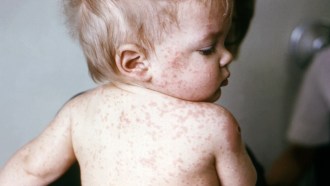 measles baby