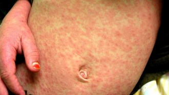 measles rash