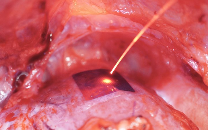 A thin pacemaker conforms to the shape of pig's heart. The pig's heart is pink with red veings and is surrounded by similar looking tissue. A laser beams down on the device from above.