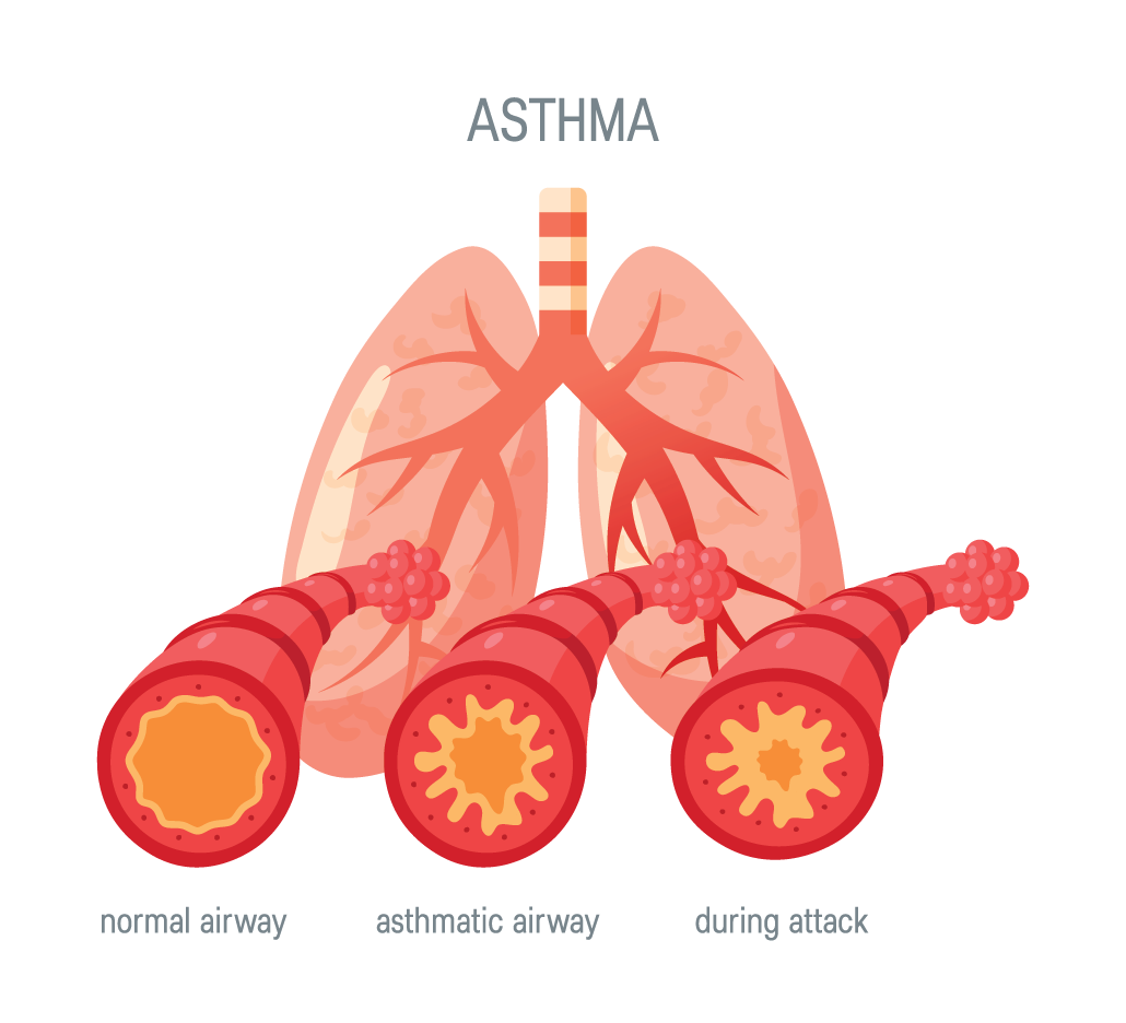 a diagram showing how asthma narrows the airways of peple with asthma, and even further narrows them during an asthma attack