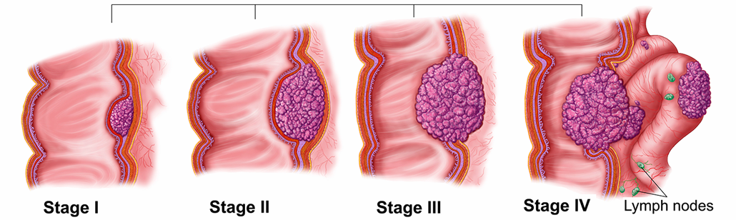 a series of illustrations showing cancer growth from Stage 1 - 4