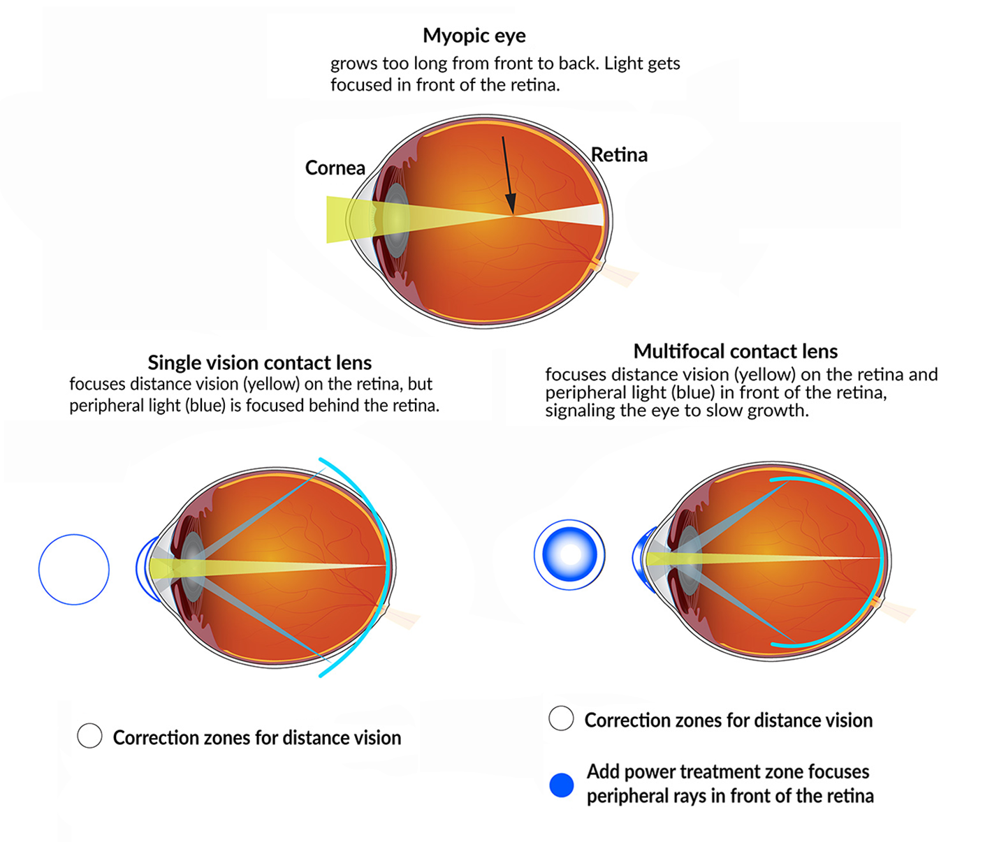 a diagram showing how light focuses in an eye with myopia, and then how it is focused for an eye wearing a multifocal or single vision contact lens