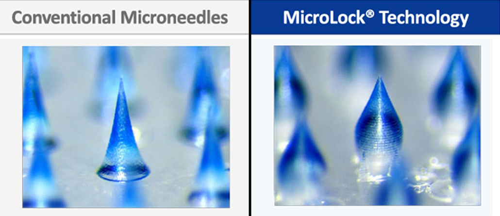 a compound image, typical microneedles to the left, a simple cone shape and microlock needles to the right with the bulb shaped base